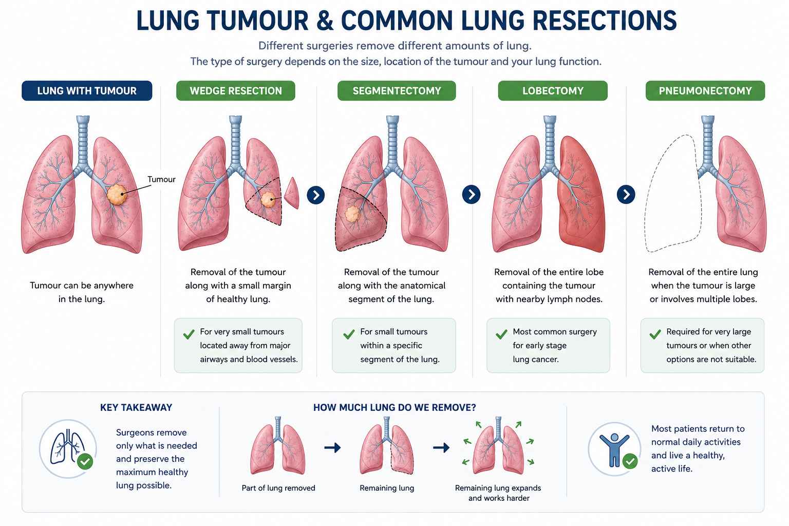 Diagram showing a lung tumour and common lung resections including wedge resection, segmentectomy and lobectomy